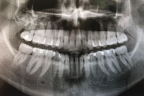 My Dental Demise After the Appalachian Trail: A Cautionary Tale