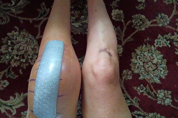 Night Before Knee Replacement Surgery
